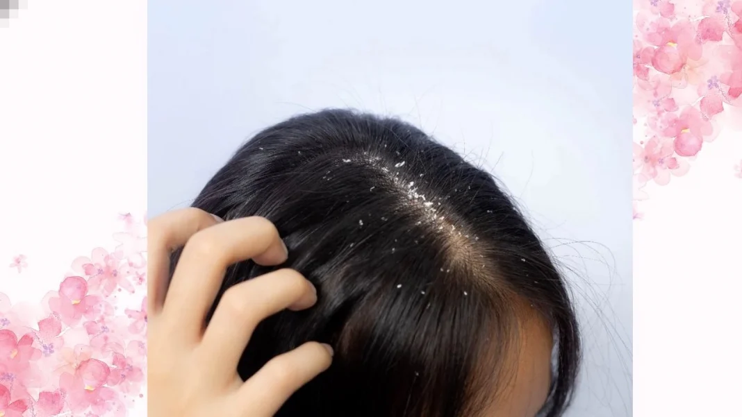 Dandruff Treatment at Home