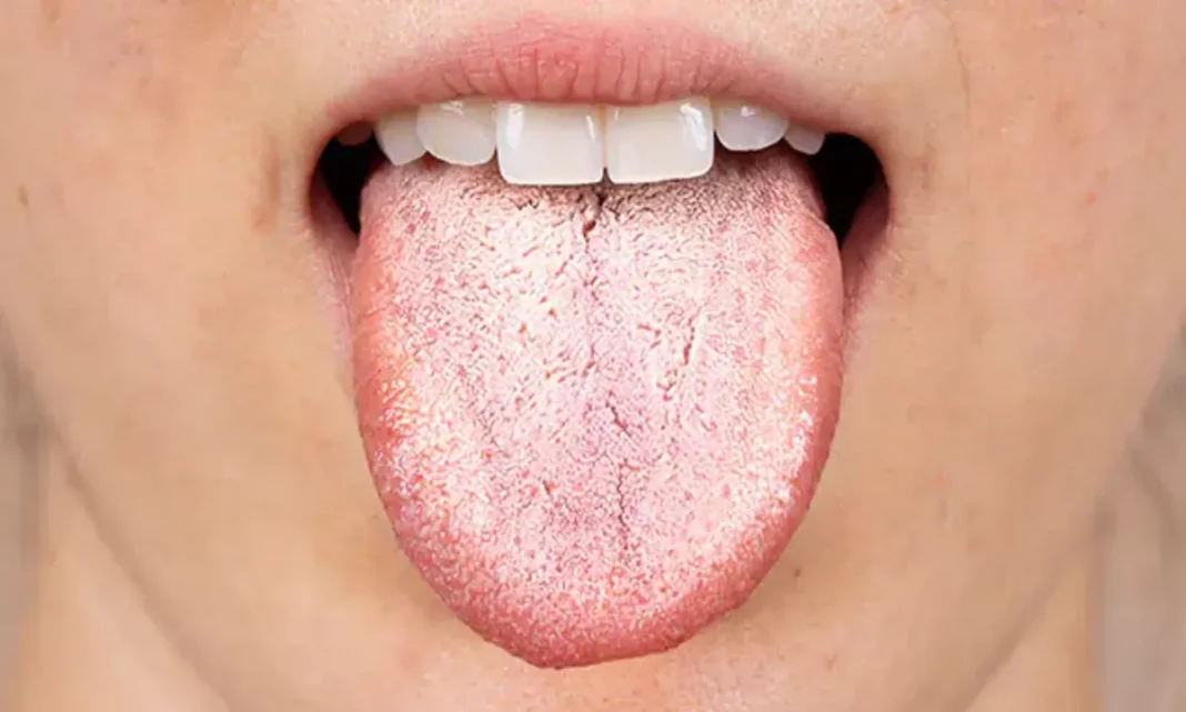 Remove White Layer In Tongue