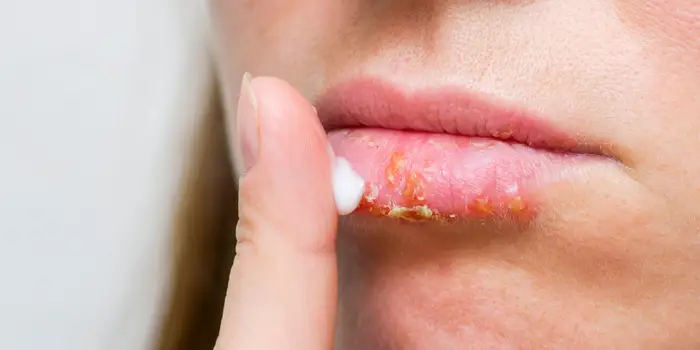 Lips Home Remedies